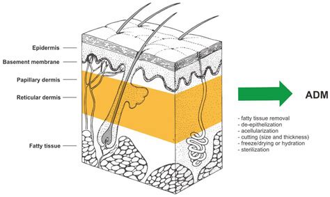 Human Acellular Dermal Matrix in Reconstructive Surgery—A Review