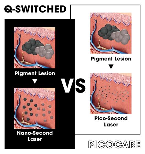 Pico Laser vs. Traditional Lasers: Revolutionizing Skin Treatments for ...