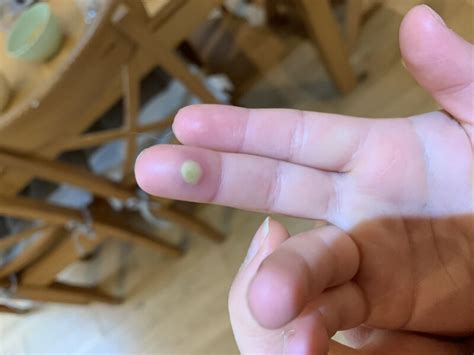 Image result for Infected Splinter Removal