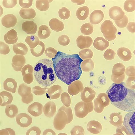 Blast Cells: Identification & Differentiation