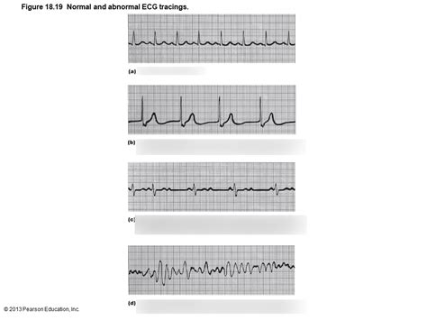 Image result for Normal vs Abnormal ECG