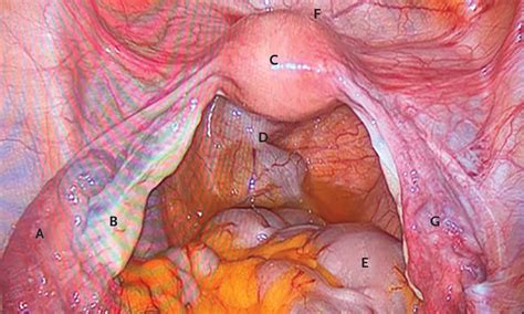 Lesions of the Ovary and Fallopian Tube | New England Journal of Medicine