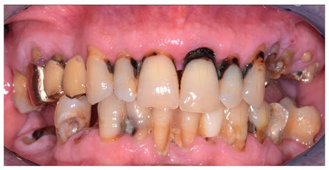 Using a Preoperative Scan Digital Impression and a Digital Index to ...