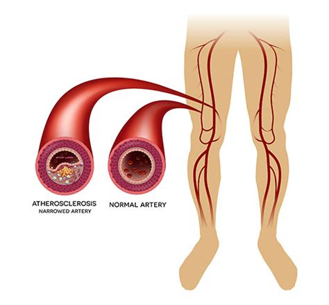 Peripheral Artery Disease (PAD) | SMT