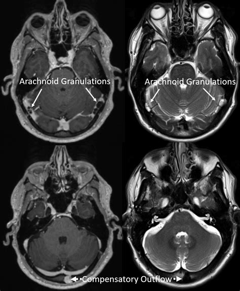 Pulsatile Tinnitus Venous Sinus Stenosis | neuroangio.org