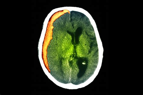 Determining the Risk of Seizures in Patients with Subdural Hematomas ...