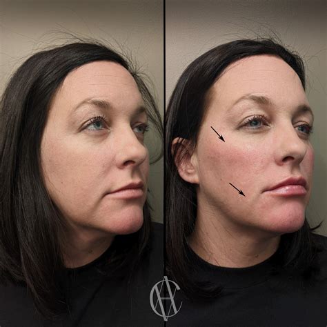 All About Marionette Lines Filler, Before and After Pictures, and More — ⬦ A-Class Aesthetics