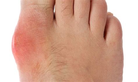 Arthritis symptoms: Most common signs - pain, stiffness, swelling and ...