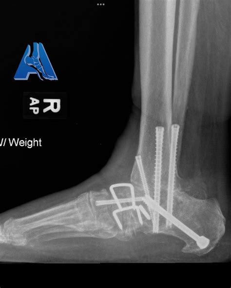 Failed Triple Arthrodesis/Flat Foot Surgery Repaired with Ankle Fusion ...