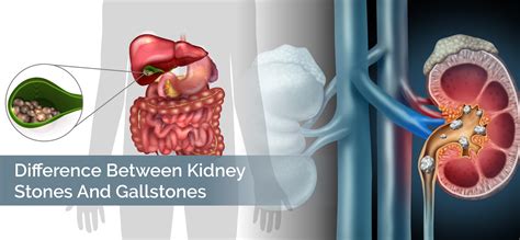 Gallstones Vs Kidney Stones