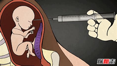 告诉你堕胎的真相,堕胎时胎儿是如何被杀死的?(惨不忍睹)_探秘志
