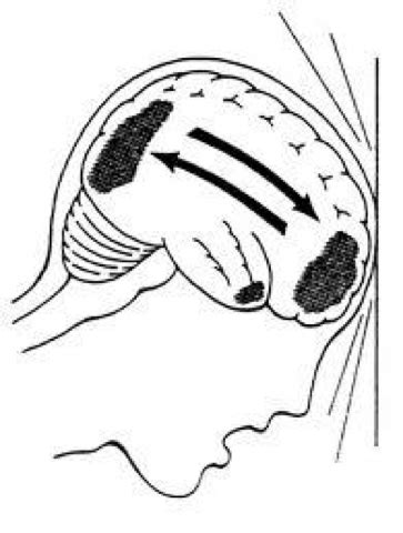 Head Injury - Cell Therapy