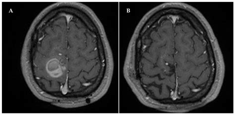 Distant Recurrence of a Cerebral Cavernous Malformation in the Vicinity of a Developmental ...