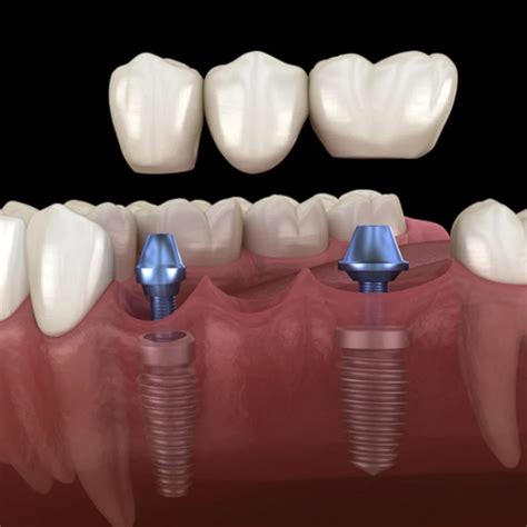 Comparing Implant Supported Bridges and Dentures - Restore in 24