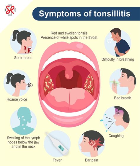 Safe Ways To Treat Tonsillitis At Home Without Antibiotics