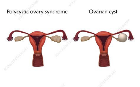 https://media.sciencephoto.com/image/f0221793/800wm/F0221793-Polycystic_ovary_syndrome%2C_illustration.jpg