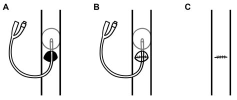 Hit and Miss: Trauma Pancreatoduodenectomy in the Setting of ...