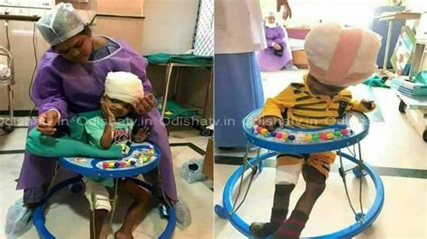 Separated conjoined twins: Jaga takes steps towards recovery