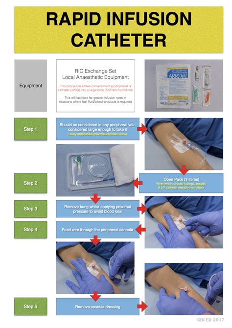 Iv Catheter How It Works at Lauren Harris blog