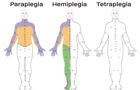 Tetraplegia - Cause, Symptoms, Treatment, Exercise