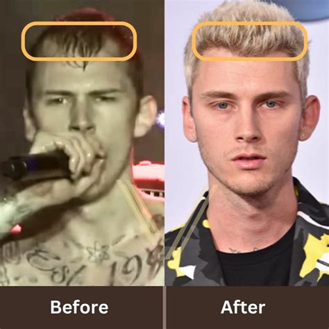 MGK's Hair Transplant: Before and After Transformation