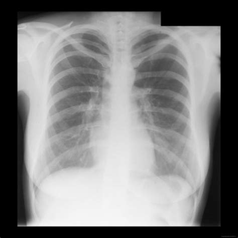 Reading The Chest X-Ray (Chest Radiography): Identifying A Normal Chest ...