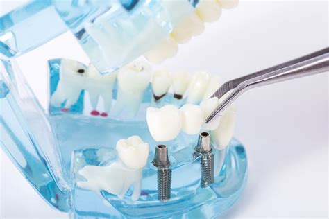 牙科医生告诉你，种植上门牙需小心谨慎 | 升艺口腔医院
