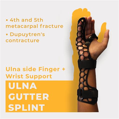 Ulnar Gutter Splint Making An Ulnar Gutter Splint For A Boxer's