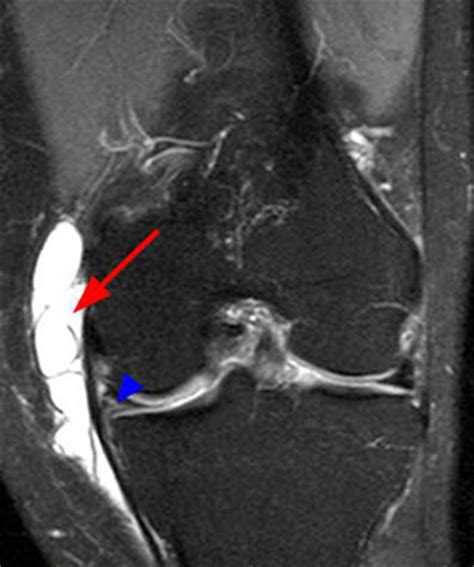 Kuvatulokset haulle pes anserine bursitis