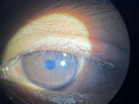 Savarkundla Lallubhai Sheth Hospital; Unusual Case Child Eye Eyelid ...