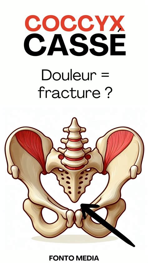 Broken collarbone clavicle fracture recovery time tips – Artofit