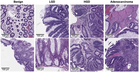 Detection of Colorectal Adenocarcinoma and Grading Dysplasia on ...