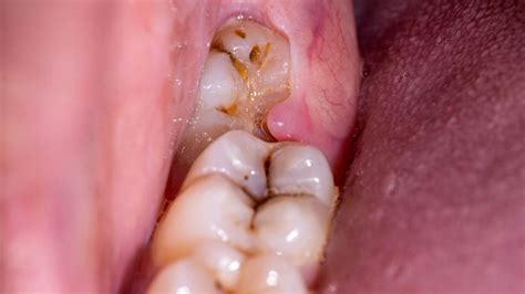 Pericoronitis Explained: Symptoms, Treatment, and Care Tips