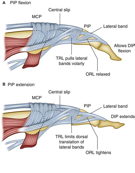 Managing Swan Neck and Boutonniere Deformities - Clinics in Plastic Surgery