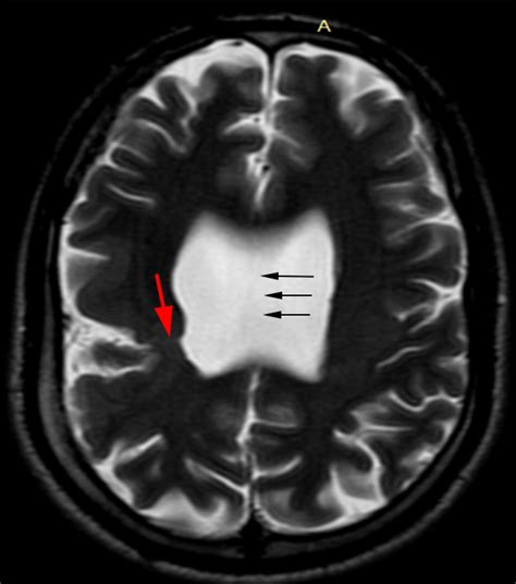 Absent Septum Pellucidum