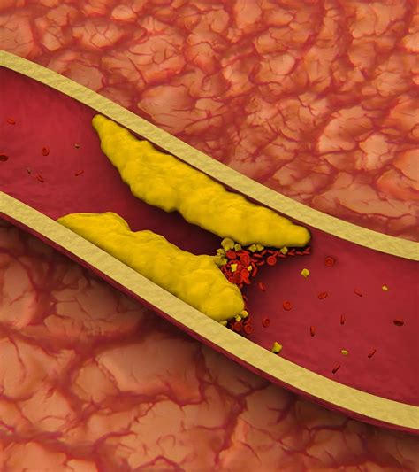 Blood Clots After Childbirth: Comprehensive Guide For New Moms