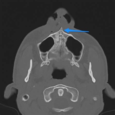 Anterior Nasal Spine Fracture