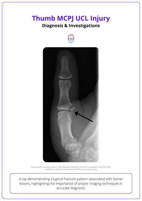 Thumb MCPJ UCL Injury: Thumb Anatomy, Diagnosis & Management
