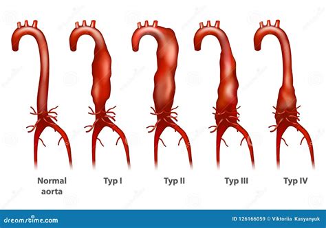 Aortic Aneurysm Vector Illustration | CartoonDealer.com #121325770