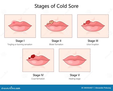 Cold Sore Stages Ocular Herpes (Eye Herpes): Symptoms & Treatment