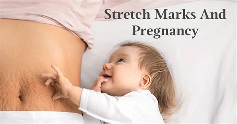 Stretch Marks During Pregnancy: Everything You Should Know – AreoVeda