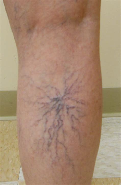 Treating Broken or Spider Veins | Laser Lipo