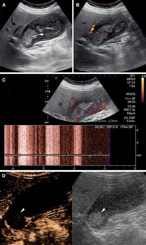 Image result for How to Remove Gallbladder Sludge