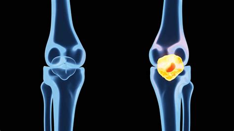 Meniscus Surgery: Is It Worth It? Cost, Procedure & Recovery