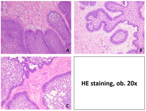 Ameloblastoma of the Mandible in a 16-Year-Old Female—Case Report