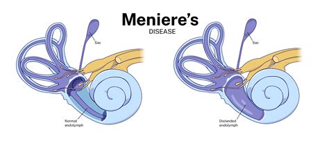 Meniere's Disease Low Blood Pressure at Chris Stevens blog