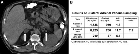 Role for adrenal venous sampling in primary aldosteronism - Surgery