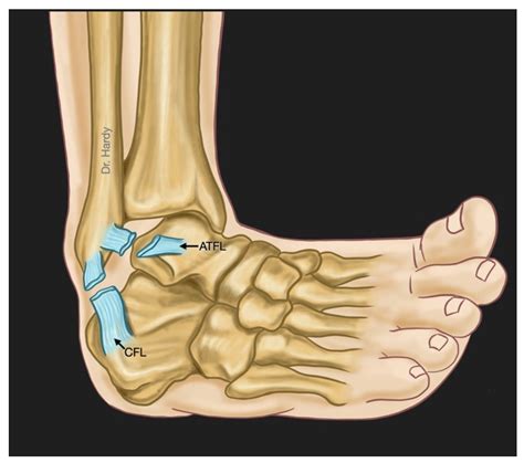 A Review of Chronic Lateral Ankle Instability and Emerging Alternative ...