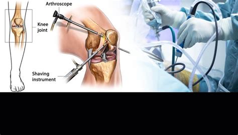 Knee Preservation and Arthroscopy in South Delhi | Dr. Yashwant Singh ...