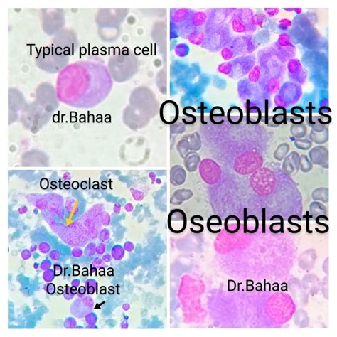 Dr. Bahaa Seada on LinkedIn: difference between osteoblasts,osteoclasts ...